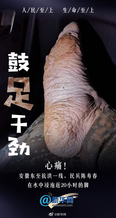 #抗洪民兵泡在水里近20小时的脚# 心疼！