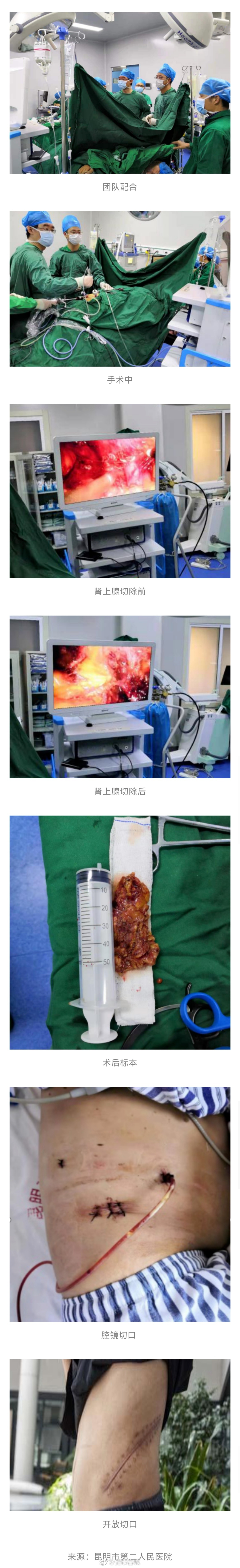 昆明市第二人民医院成功开展首例腹膜后腹腔镜下肾上腺肿瘤切除术
