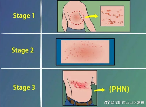 带状疱疹春天高发，72小时内务必处理