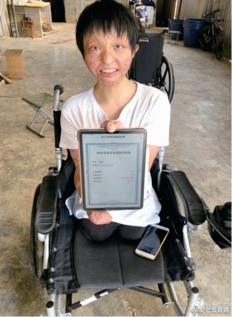 祝贺！昆明“浴火女孩”唐敏收到大学录取通知书