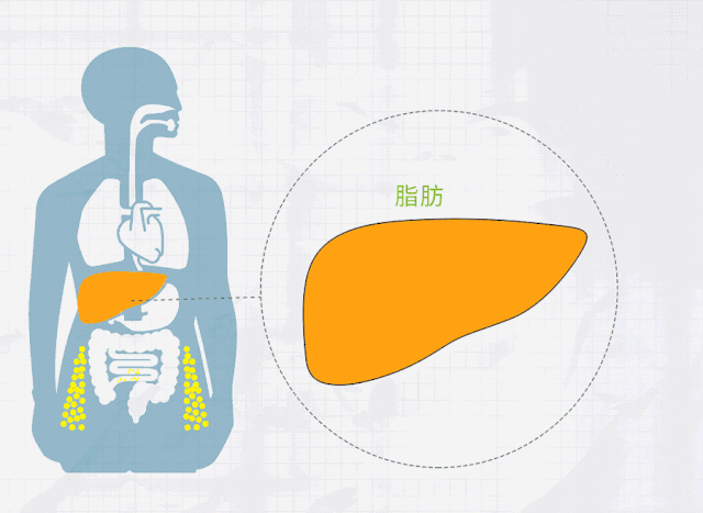 明明不胖怎么就脂肪肝了