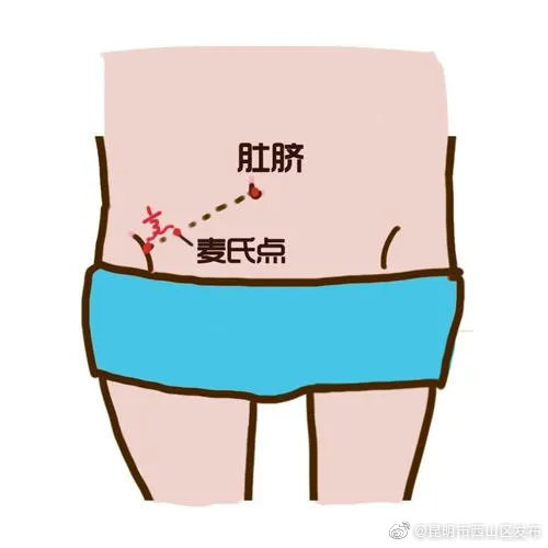 阑尾炎是怎么个疼法？先肚脐周围疼，后右下腹疼
