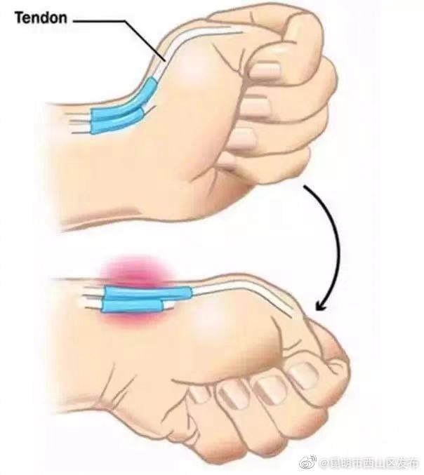 一个动作自测有无腱鞘炎 