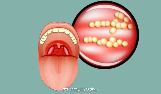 什么样的扁桃体要切除 ？出现4种变化时别犹豫了