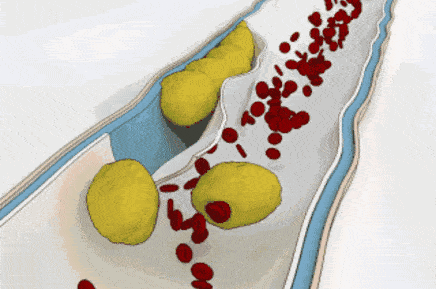 4种症状警惕血液粘稠 