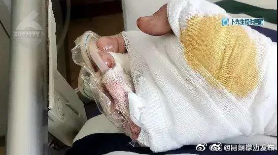 痛心！昆明14岁少年放鞭炮炸断2根手指