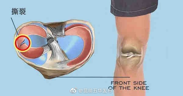 5个迹象提示半月板伤了