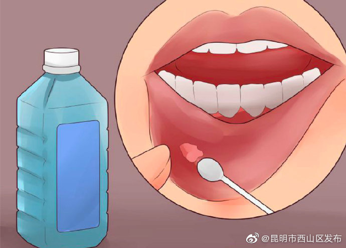 口腔溃疡超过两周要警惕
