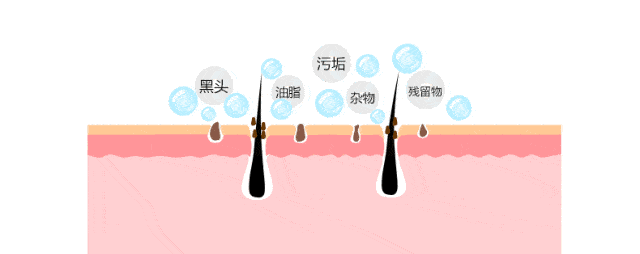 皮肤科专家教你5个办法祛黑头