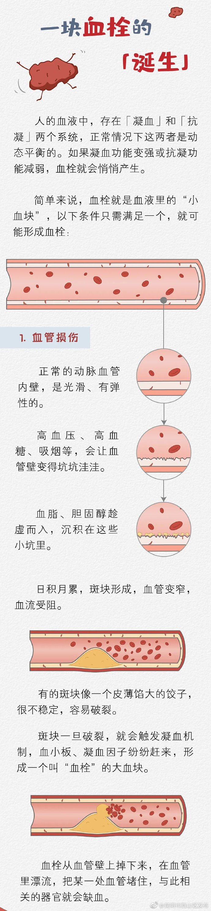 一张图还原血栓的诞生