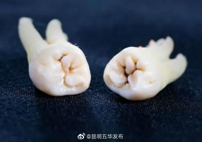 牙齿出现黑线意味着什么