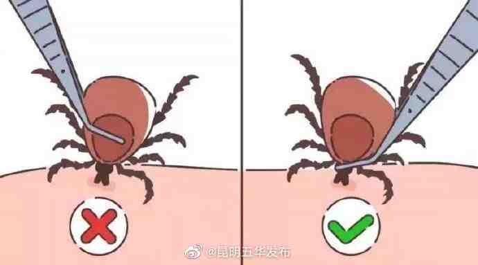 被蜱虫叮咬千万不要硬拉