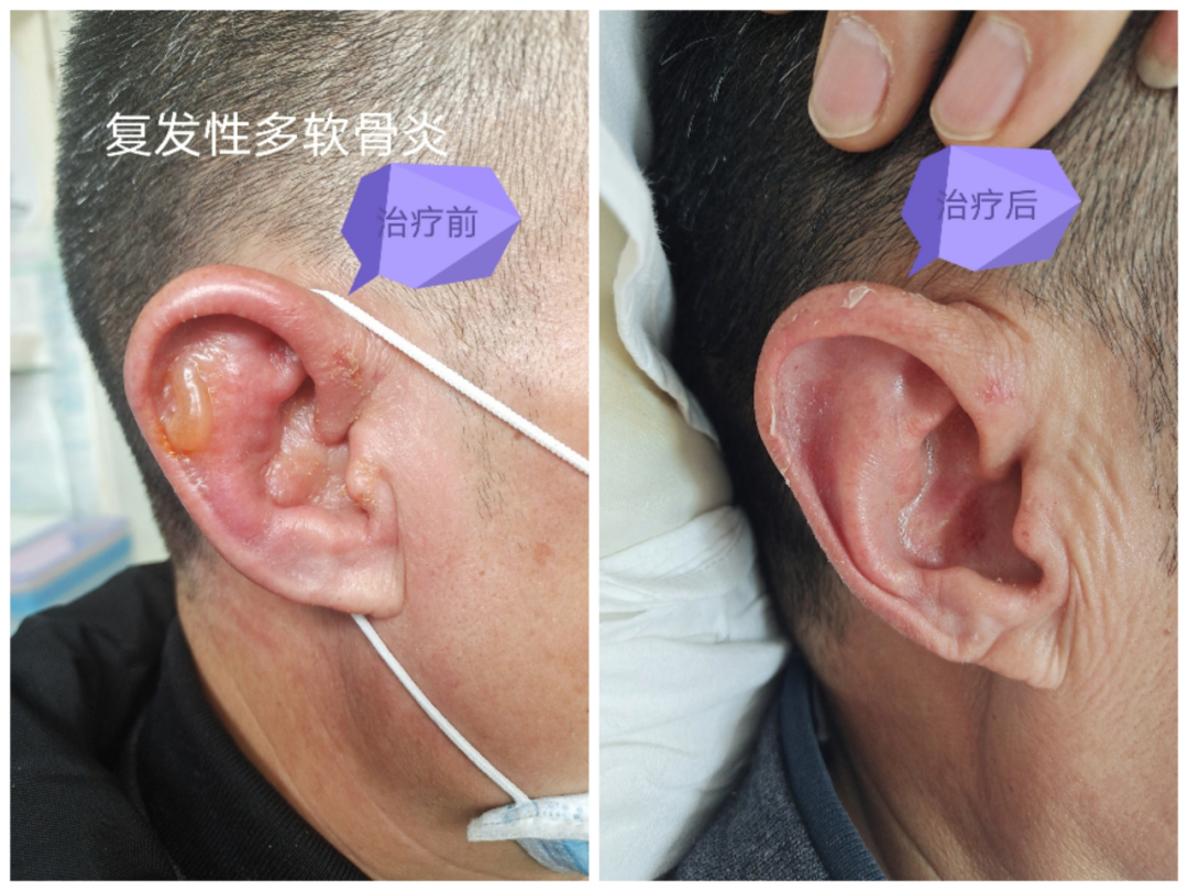 经过相关检查,周先生被诊断为"复发性多软骨炎",这次经治疗后病情好转