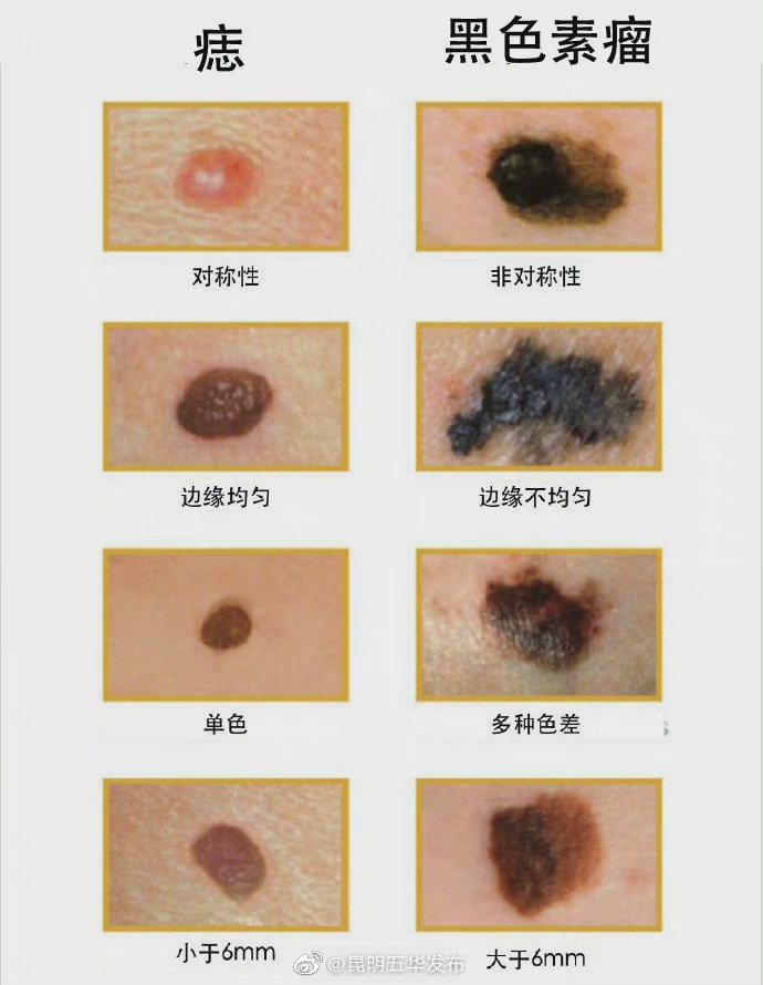 一图识别痣和黑色素瘤