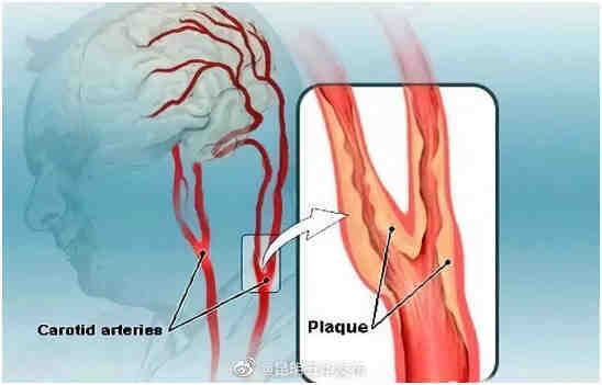 打喷嚏猛扭头可能导致血管破裂 