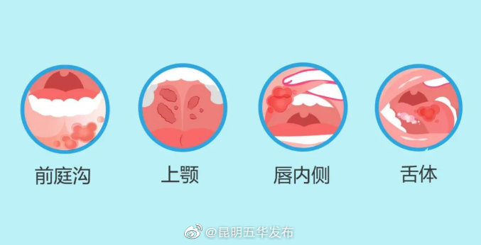 得了口腔溃疡这样做好得快