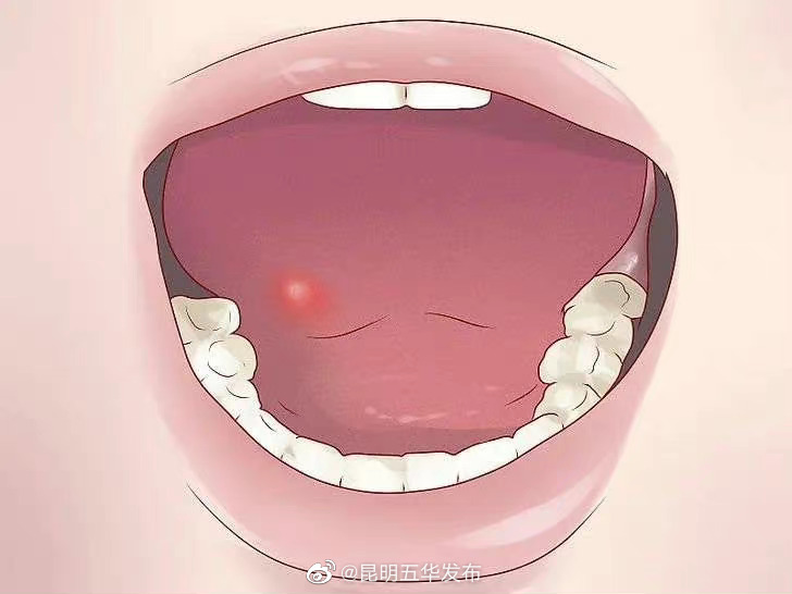 两招快速缓解口腔溃疡