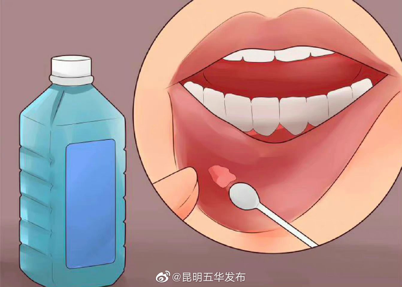 如何快速缓解口腔溃疡