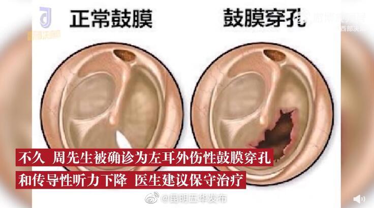 鼓膜穿孔是怎么形成的？