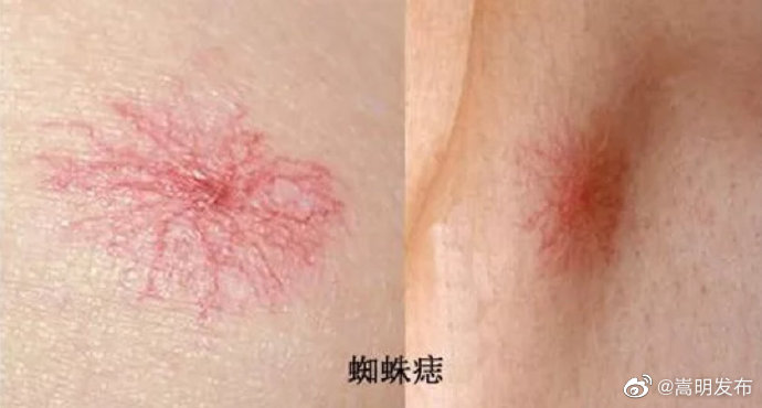 身上长这种“痣”可能是肝癌信号