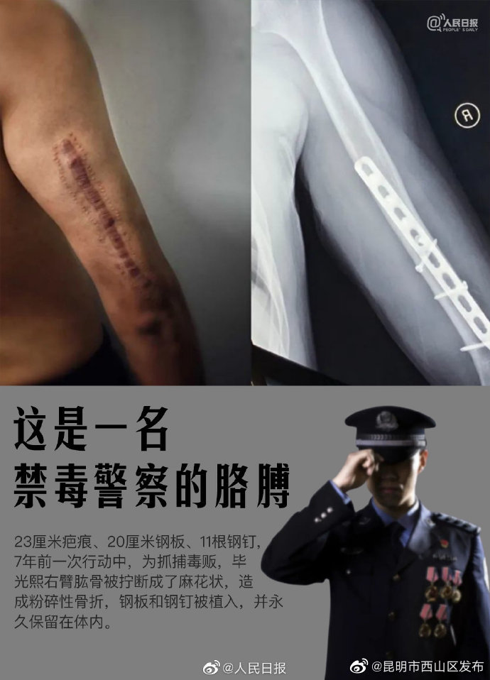 看着都疼！缉毒警右臂有11根永久性钢钉
