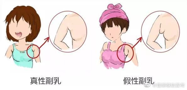 副乳也分真假，乳腺科医生教你区分