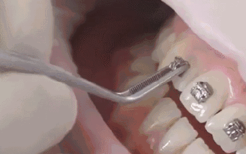矫正牙齿把握3个黄金期