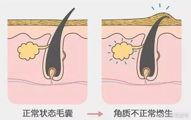 为什么有些人的皮肤长得像鸡皮？