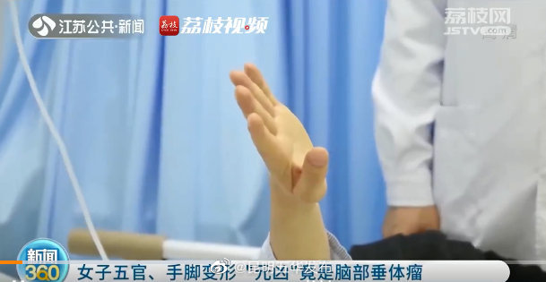 良性脑肿瘤也需警惕