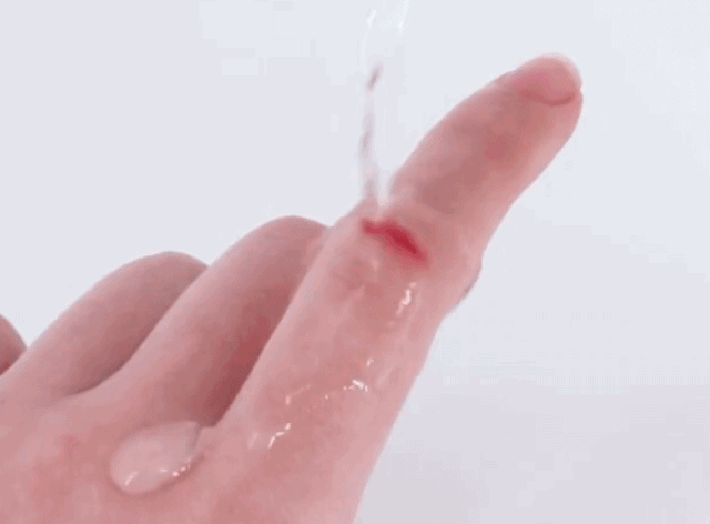 4种伤口不能用液体创可贴