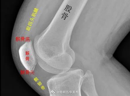 女性的膝盖更易跑偏，一个动作快速自查髌骨