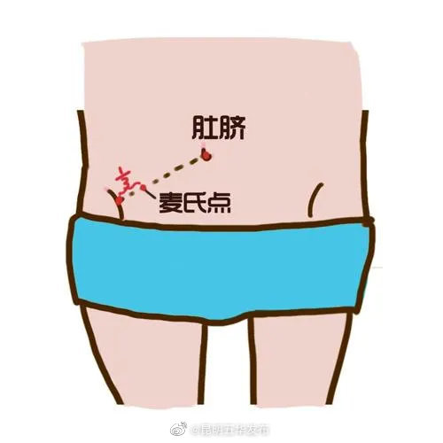 阑尾炎发作是怎么个疼法？