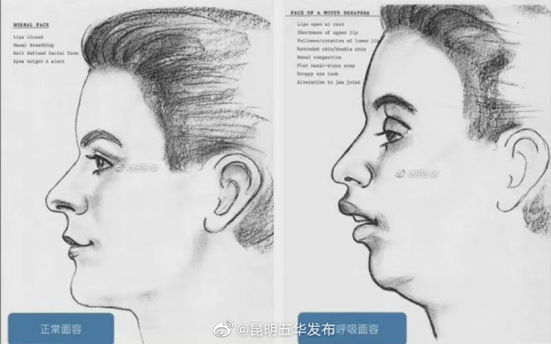 口呼吸不只影响颜值,还会影响健康