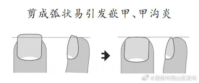 指甲太短易患甲沟炎