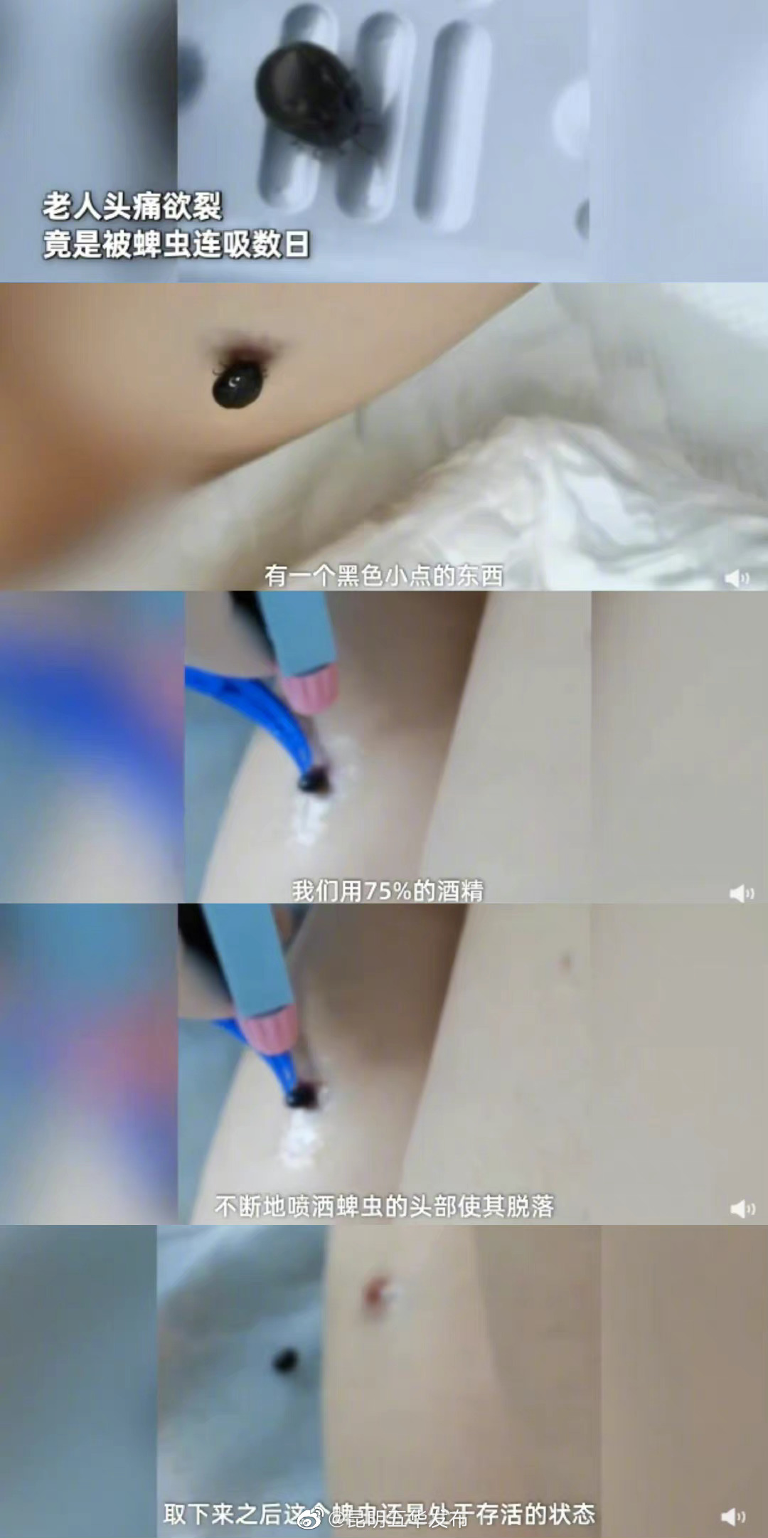 被蜱虫叮咬后切勿硬拽