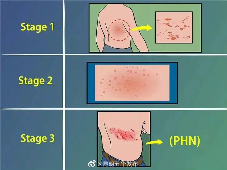 带状疱疹发病3天内治疗效果好