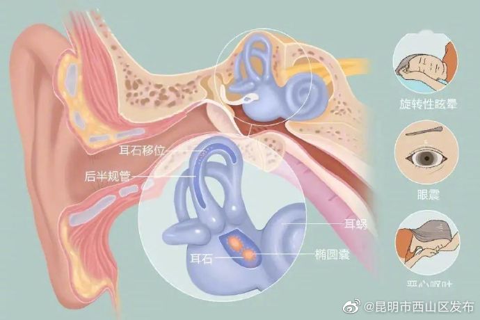 一躺下就头晕当心耳石症