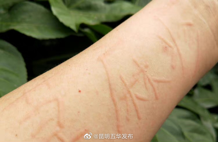 给荨麻疹患者5个实用建议