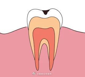 牙齿是如何黑化的 
