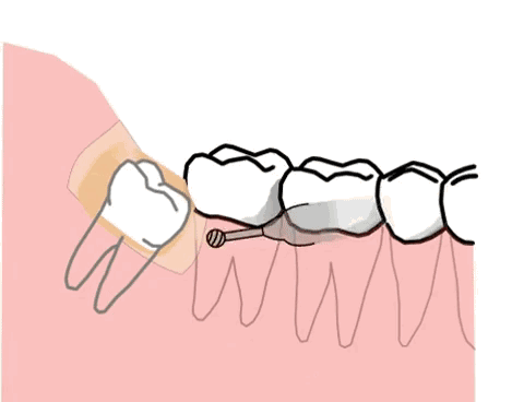拔智齿有最佳时期