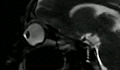 经常揉眼睛会让角膜变形