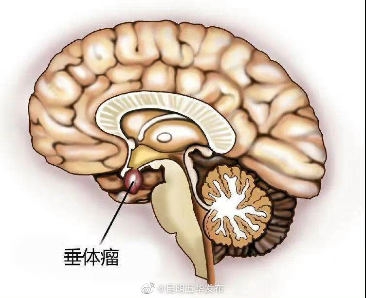 有种肿瘤会让身体变形