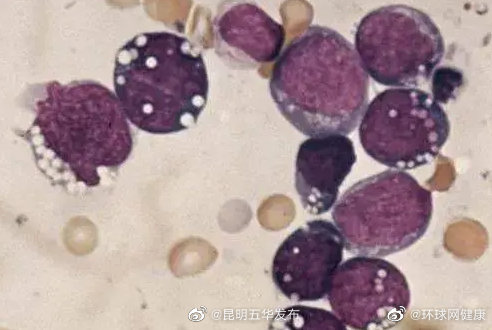 EB病毒为什么被称为“亲吻病毒”