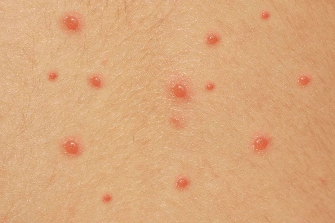 云南疾控
