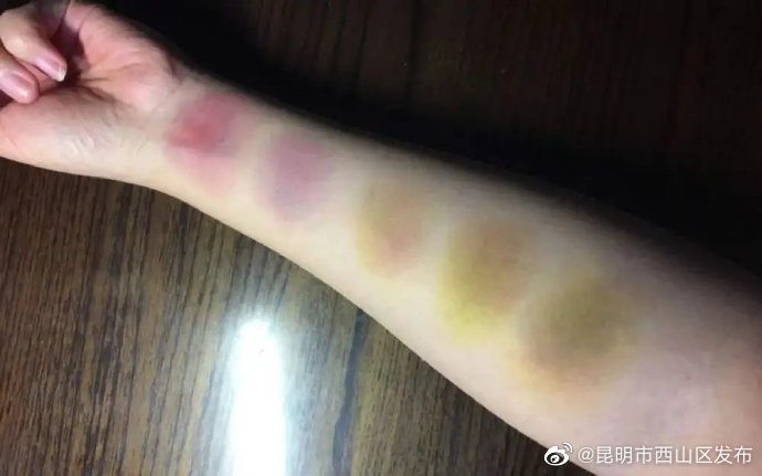 磕碰之后为什么淤青会变色？