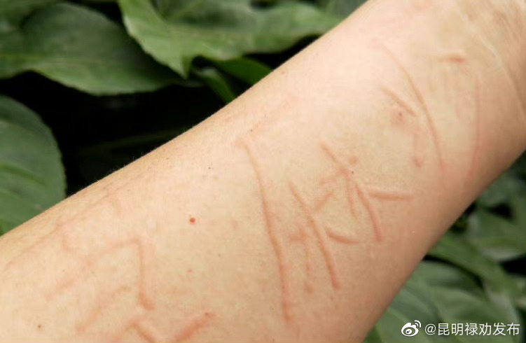 如何减少荨麻疹发作