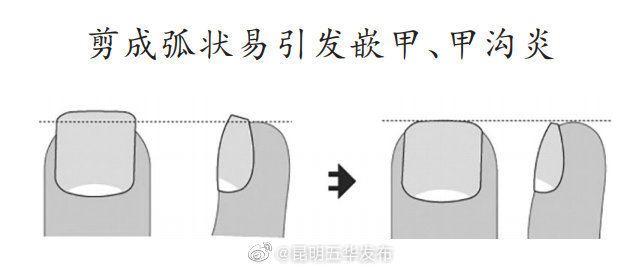 指甲剪太短容易得甲沟炎