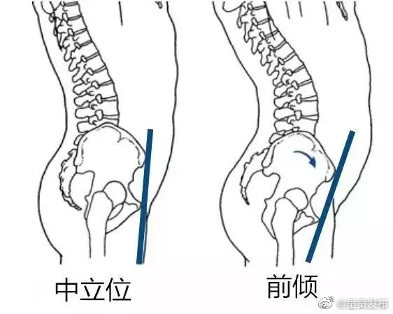 有种小肚子叫骨盆前倾