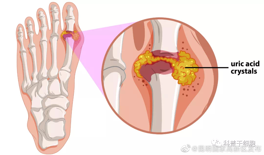 痛风救星，干细胞不仅“止”痛，更“治”痛