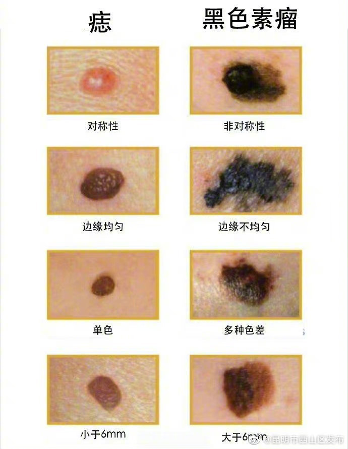 什么样的痣可能会癌变 